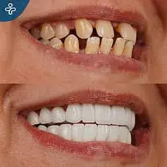 Full Mouth Dental Veneers in Turkey Before and After