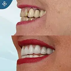 Full Smile Makeover Before&After