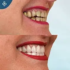 Full Smile Makeover Before&After