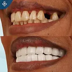 Hollywood Smile Accomplished