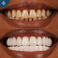 Hollywood Smile Accomplished