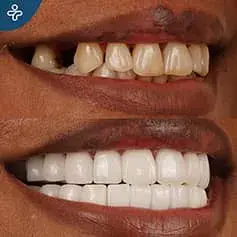 Hollywood Smile Accomplished
