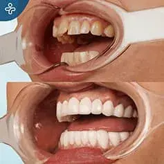 Full Mouth Dental Implants