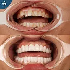 Full Mouth Dental Implants