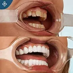 Full Mouth Dental Implants