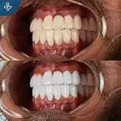 Laser Teeth Whitening Before and After