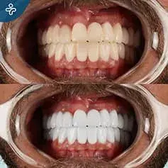 Laser Teeth Whitening Before and After