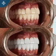 Laser Teeth Whitening Before and After