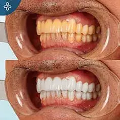 In-Depth Whitening