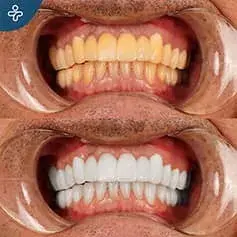 In-Depth Whitening