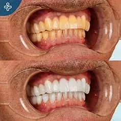 In-Depth Whitening