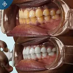 Hard Teeth Whitening in Turkey Before and After