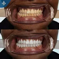 Hard Teeth Whitening in Turkey Before and After