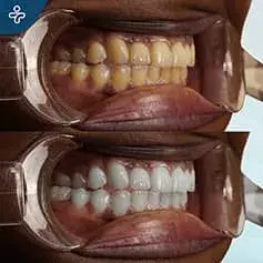 Hard Teeth Whitening in Turkey Before and After