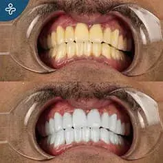 Snow White Laser Treatment