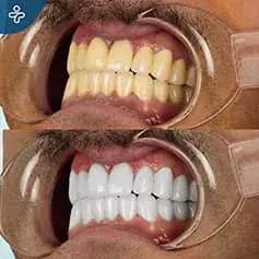 Snow White Laser Treatment