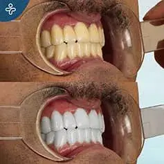 Snow White Laser Treatment