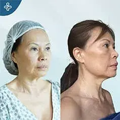 Extended Deep Plane Facelift in Turkey