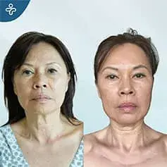 Extended Deep Plane Facelift in Turkey