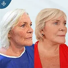Facelift & Blepharoplasty in Turkey