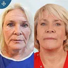 Facelift & Blepharoplasty in Turkey