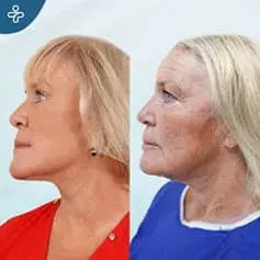 Facelift & Blepharoplasty in Turkey