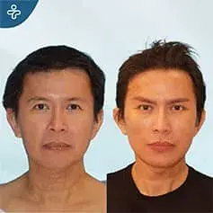 Full Face Rejuvenation Before and After