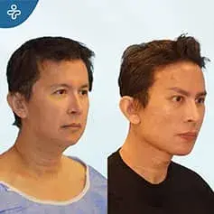 Full Face Rejuvenation Before and After