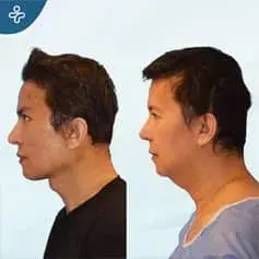 Full Face Rejuvenation Before and After