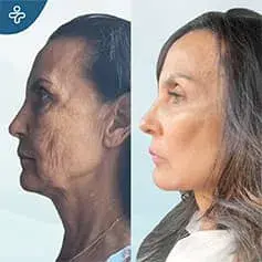 Extended Deep Plane Facelift & Neck Lift