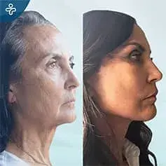 Extended Deep Plane Facelift & Neck Lift