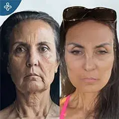 Extended Deep Plane Facelift & Neck Lift
