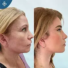 High SMAS Facelift Before and After