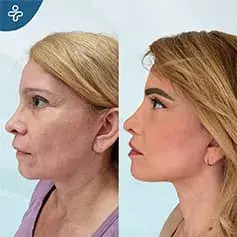 High SMAS Facelift Before and After