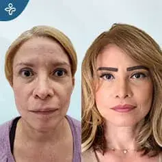 High SMAS Facelift Before and After