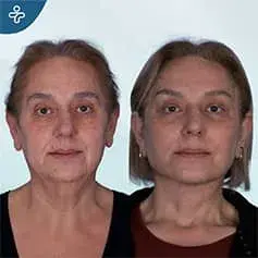 Extended Deep Plane Facelift Before and After