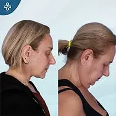 Extended Deep Plane Facelift Before and After