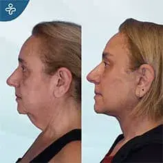 Extended Deep Plane Facelift Before and After