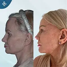 Extended High SMAS Facelift in Turkey Before and After