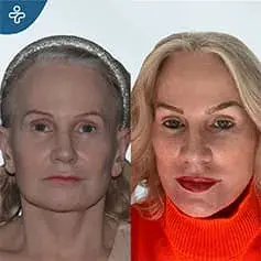 Extended High SMAS Facelift in Turkey Before and After