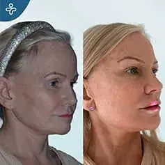 Extended High SMAS Facelift in Turkey Before and After