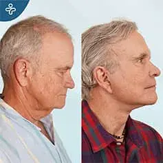 Rhytidectomy Before and After