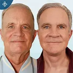 Rhytidectomy Before and After