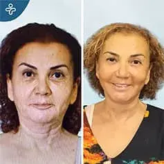 Post Weight Loss Neck Lift
