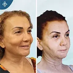 Post Weight Loss Neck Lift