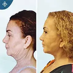Post Weight Loss Neck Lift