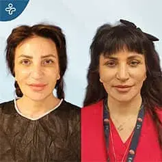 Neck Lift Surgery Before and After