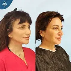 Neck Lift Surgery Before and After