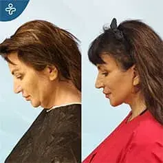 Neck Lift Surgery Before and After