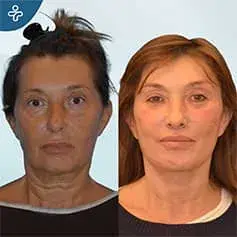 Full Neck Lift Surgery Before and After